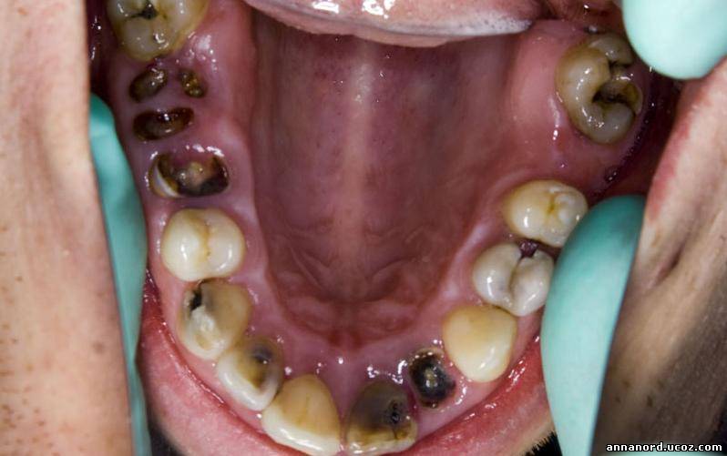 Что будет если долго не лечить кариес эдельвейс стоматология томск официальный сайт
